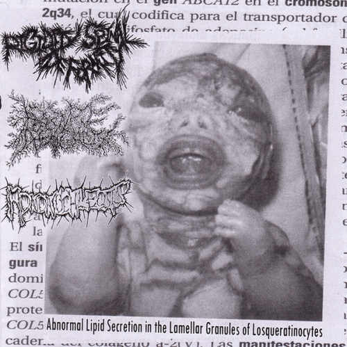 Mononuchleosis : Abnormal Lipid Secretion in the Lamellar Granules of Losqueratinocytes
